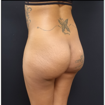 25-34 year old woman treated with 712cc Implants and Fat Transfer for her Butt Augmentation before 3129103