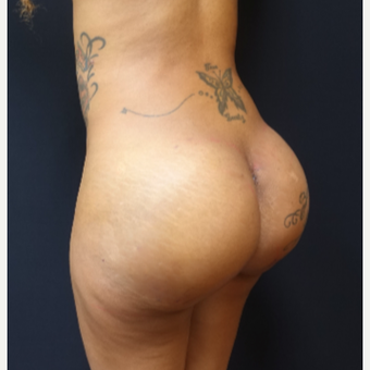 25-34 year old woman treated with 712cc Implants and Fat Transfer for her Butt Augmentation after 3129103