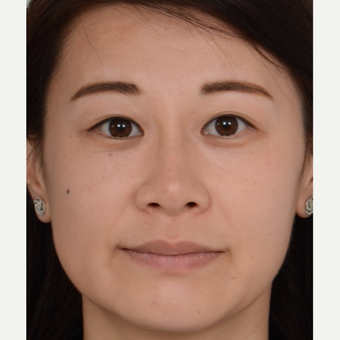 25-34 year old Asian woman treated with Non Surgical Nose Job after 2918608