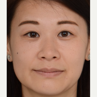 25-34 year old Asian woman treated with Non Surgical Nose Job before 2918608