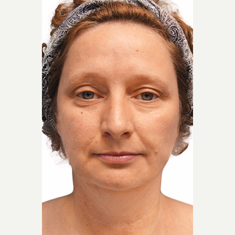 35-44 year old woman treated with Brow Lift before 2869844