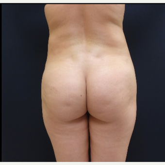 25-34 year old woman treated with Butt Augmentation using 712cc Butt Implants before 3259497
