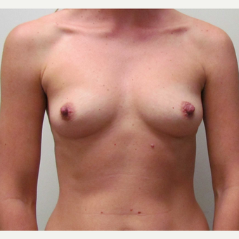 Inspira Breast Implants for this 37 Year Old Woman before 3148827