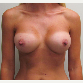 Inspira Breast Implants for this 37 Year Old Woman after 3148827