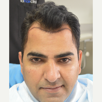 45-54 year old man treated with FUE Hair Transplant before 3105040