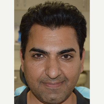 45-54 year old man treated with FUE Hair Transplant after 3105040