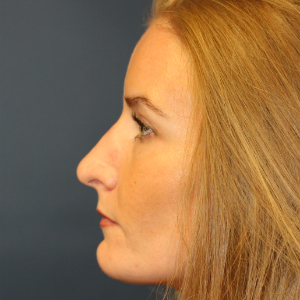 35-44 year old woman treated with Rhinoplasty before 3559724