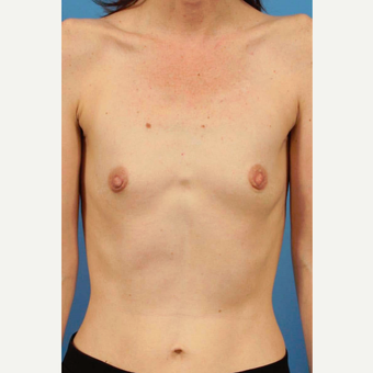 35-44 year old woman treated with Breast Implants before 3787021