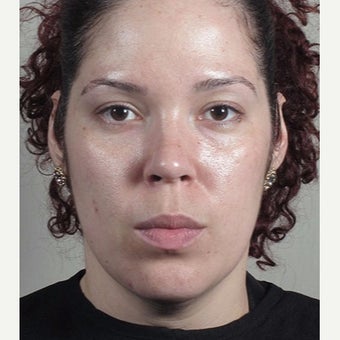 35-44 year old woman treated with Halo Laser after 1909022