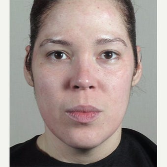 35-44 year old woman treated with Halo Laser before 1909022