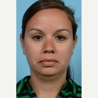 25-34 year old woman treated with Chin Implant and Sub-Mental Liposuction before 3708949