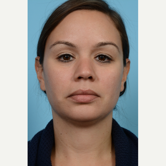 25-34 year old woman treated with Chin Implant and Sub-Mental Liposuction after 3708949