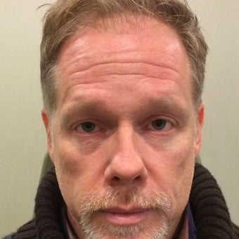 45-54 year old man treated with Voluma to his cheeks and botox to his forehead before 1754665