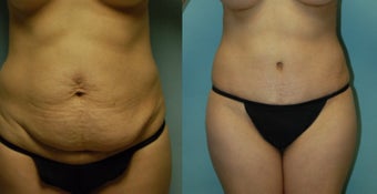 44 year old woman seven months after gel breast augmentation, drainless tummy tuck and vaser. before 3261040