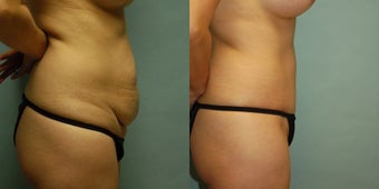 44 year old woman seven months after gel breast augmentation, drainless tummy tuck and vaser. after 3261040