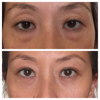 Young Asian woman who underwent lower blepharoplasty (eye bags surgery) before 2235477