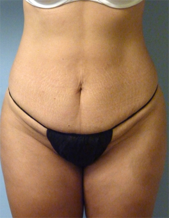 Tummy Tuck - 44 Year Old before 1371051
