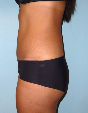 Tummy Tuck - 44 Year Old 1371051