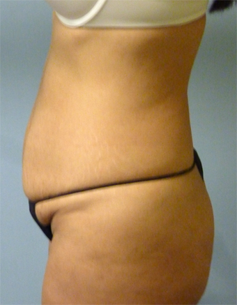 Tummy Tuck - 44 Year Old 1371051