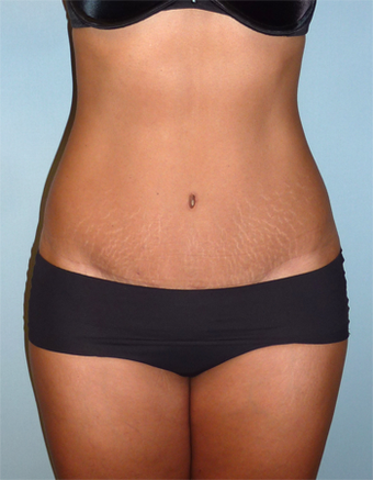 Tummy Tuck - 44 Year Old after 1371051