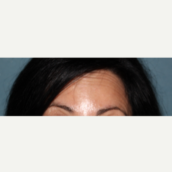 45-54 year old woman treated with 16 units of Botox after 3185646
