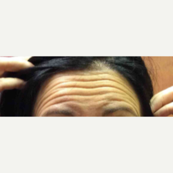 45-54 year old woman treated with 16 units of Botox before 3185646