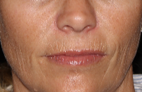 45-54 year old woman treated with Restylane Silk after 3025866
