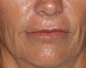 45-54 year old woman treated with Restylane Silk before 3025866