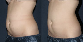 Before & After CoolSculpting before 678453