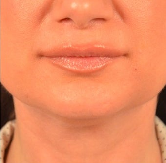 45-54 year old woman treated with Kybella after 2095842
