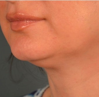 45-54 year old woman treated with Kybella 2095842