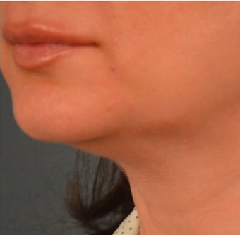 45-54 year old woman treated with Kybella 2095842