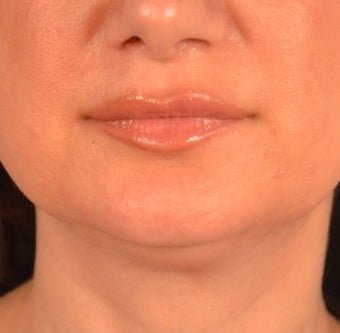 45-54 year old woman treated with Kybella before 2095842