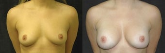 27 year old woman treated with Breast Augmentation before 2990462