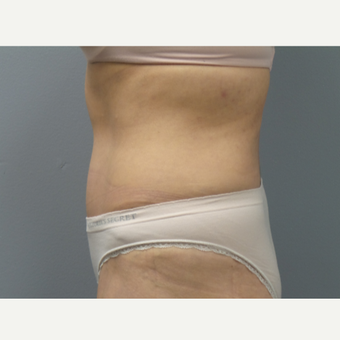 45-54 year old woman treated with Tummy Tuck after 3325460