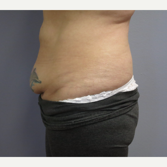 45-54 year old woman treated with Tummy Tuck before 3325460