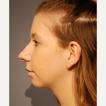 18-24 year old woman treated with Rhinoplasty before 3064878