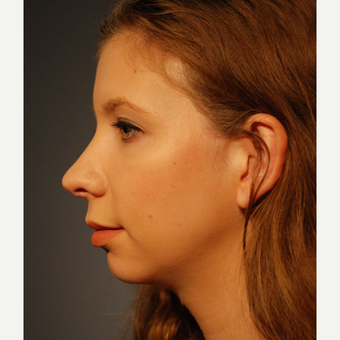 18-24 year old woman treated with Rhinoplasty after 3064878