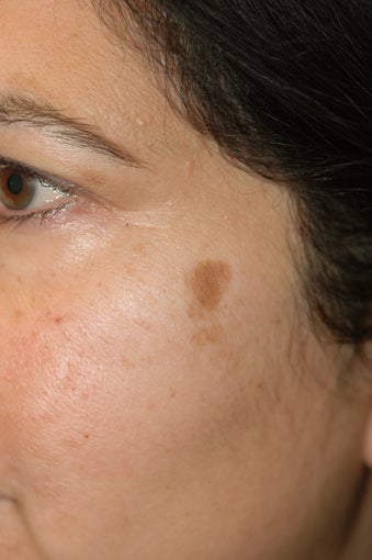 Los Angeles Age Spot Removal before 1134357