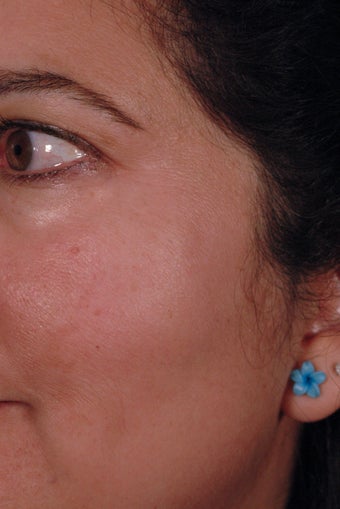 Los Angeles Age Spot Removal after 1134357