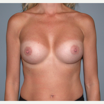 35-44 year old woman treated with Breast Augmentation after 3455317