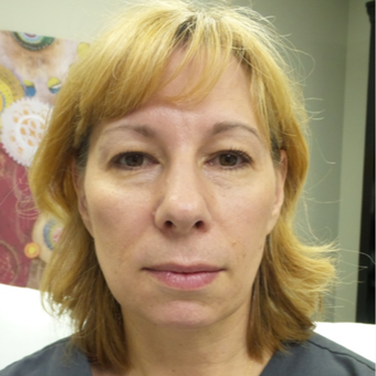 45-54 year old woman treated with Voluma before 3440489