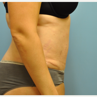 33 year old woman treated with Tummy Tuck after 3583971