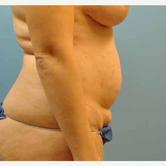 33 year old woman treated with Tummy Tuck before 3583971