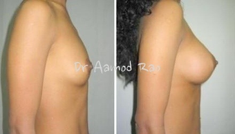 Breast Augmentation before 1282985