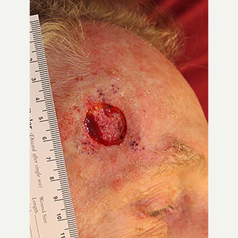 Complex Mohs Repair of the Forehead before 3176465