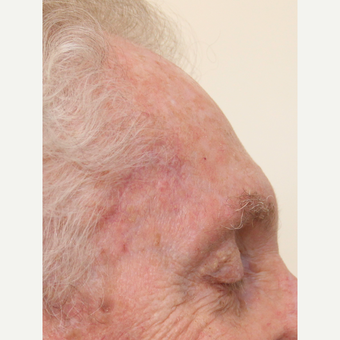 Complex Mohs Repair of the Forehead after 3176465