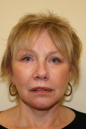 Cheek Augmentation after 1622488