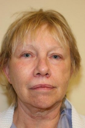 Cheek Augmentation before 1622488