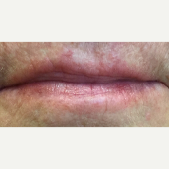 55-64 year old woman treated with Juvederm and Restylane before 3092368